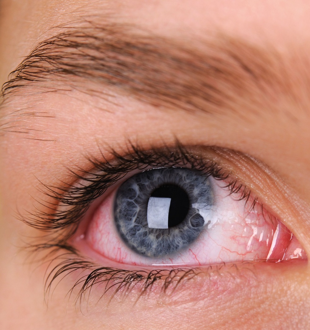 Кто больше всего подвержен синдрому красного глаза