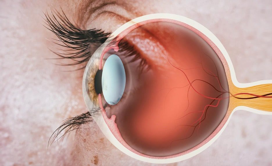 Cili është ndryshimi midis çarjes dhe shkëputjes së retinës?